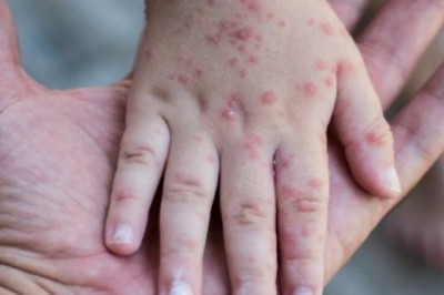 यूपी में मंकीपॉक्स: कक्षा तीन के चार छात्रों में मिले संदिग्ध लक्षण, स्कूल ने की छुट्टी